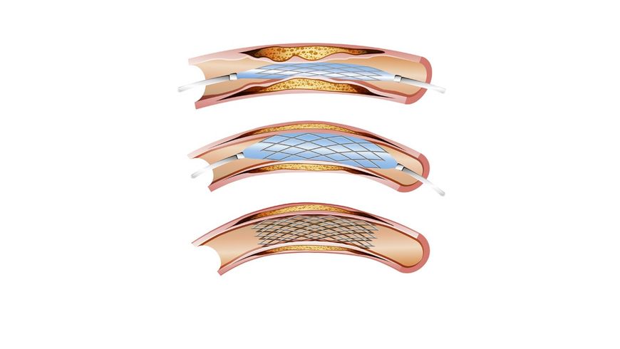 Stents: en pose-t-on trop?